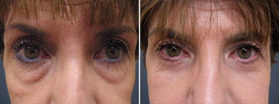Eyelid Surgery before and after photos in Princeton, NJEyelid Surgery Before and After Photos in Princeton, NJ