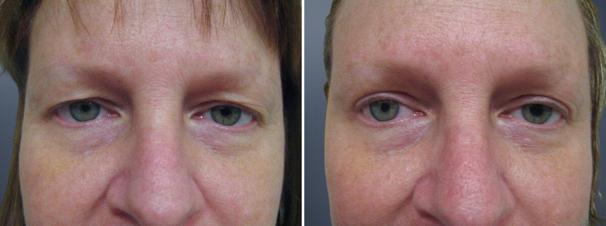 Before and after Eyelid Surgery by Dr. David W. Allison, Patient 1553