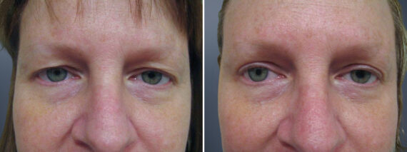 Before and after Eyelid Surgery by Dr. David W. Allison, Patient 1553