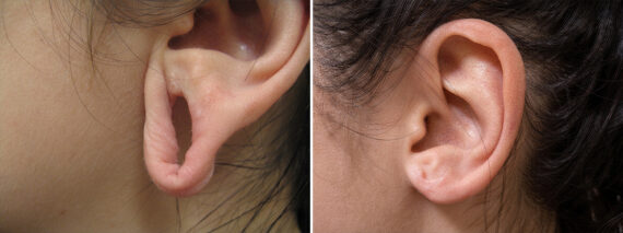 Ear Gauge Repair before and after photos in Princeton, NJEar Gauge Repair Before and After Photos in Princeton, NJ