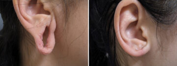 Before and after Ear Gauge Repair by Dr. David W. Allison, Patient 1557