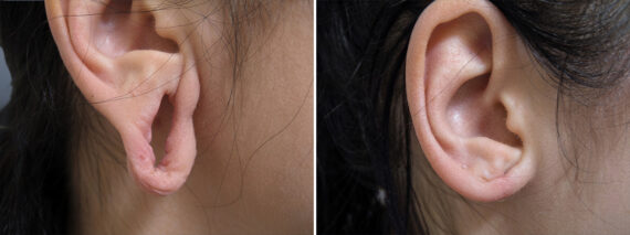 Ear Gauge Repair before and after photos in Princeton, NJEar Gauge Repair Before and After Photos in Princeton, NJ