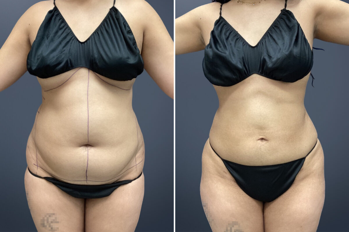 Before and after Mini Tummy Tuck by Dr. David W. Allison, Patient 6040