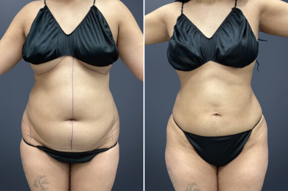 Mini Tummy Tuck before and after photos in Princeton, NJMini Tummy Tuck Before and After Photos in Princeton, NJ