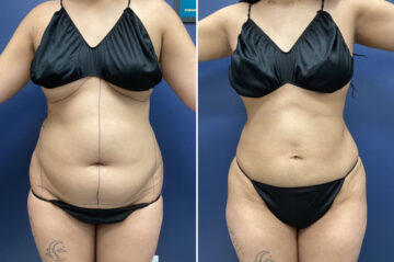 Before and after Mini tummy tuck by Dr. David W. Allison, Patient 6040