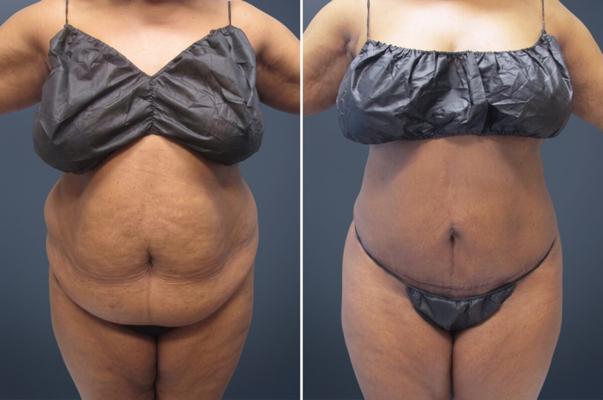 Before and after Mini Tummy Tuck by Dr. David W. Allison, Patient 6044