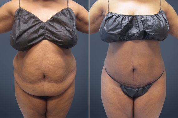 Mini Tummy Tuck before and after photos in Princeton, NJMini Tummy Tuck Before and After Photos in Princeton, NJ