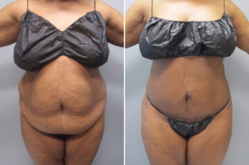 Before and after Mini tummy tuck by Dr. David W. Allison, Patient 6044