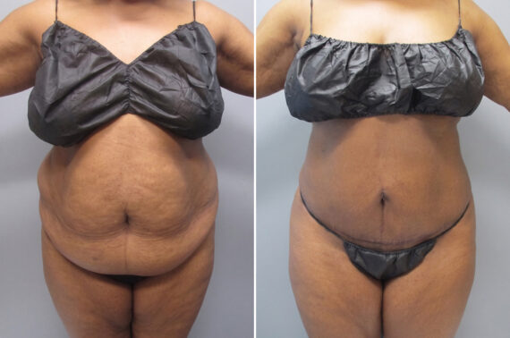 Before and after Mini tummy tuck by Dr. David W. Allison, Patient 6044