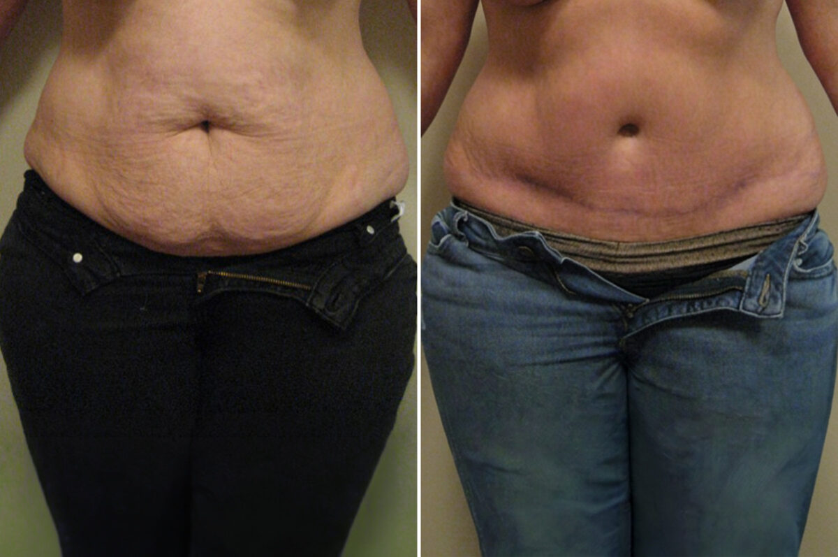 Before and after Tummy Tuck by Dr. David W. Allison, Patient 6048