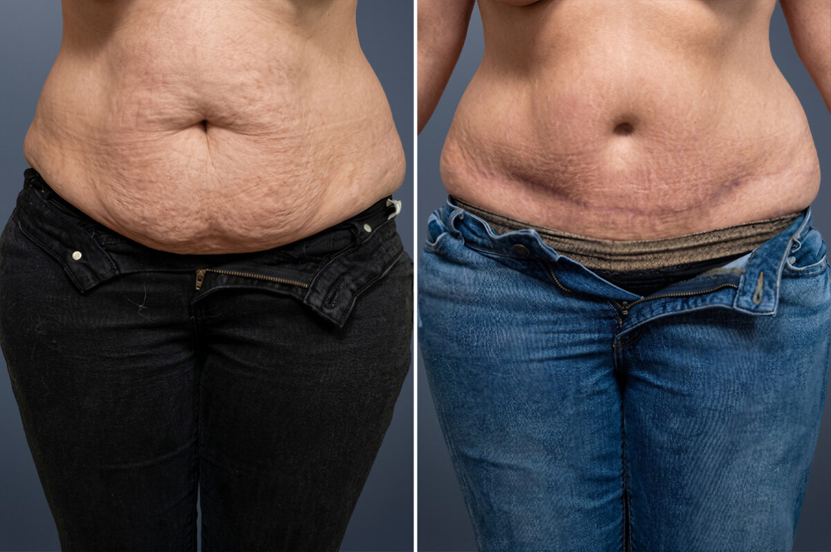 Before and after Tummy Tuck by Dr. David W. Allison, Patient 6048