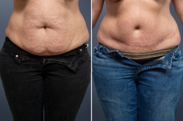 Before and after Tummy Tuck by Dr. David W. Allison, Patient 6048