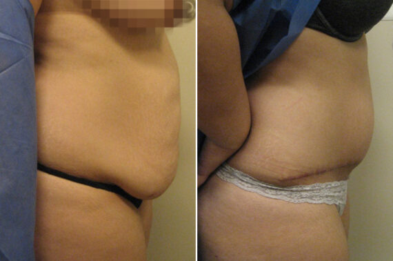Before and after Tummy Tuck by Dr. David W. Allison, Patient 6057