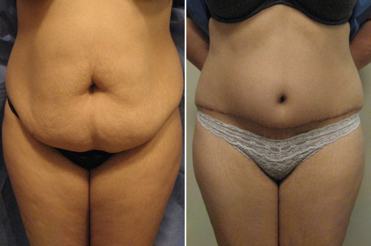 Before and after Tummy Tuck by Dr. David W. Allison, Patient 6057