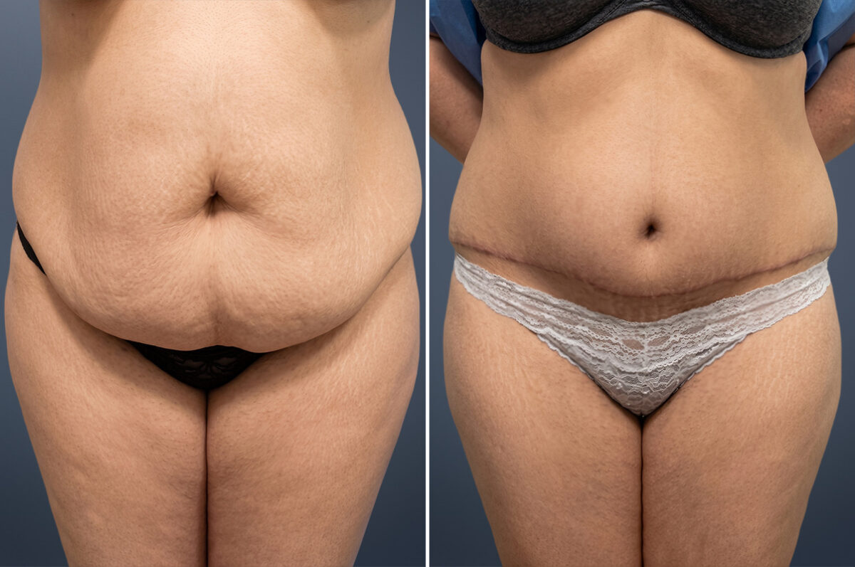 Before and after Tummy Tuck by Dr. David W. Allison, Patient 6057
