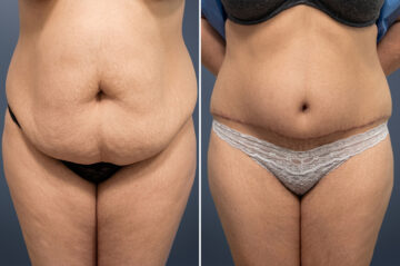 Before and after Tummy Tuck by Dr. David W. Allison, Patient 6057
