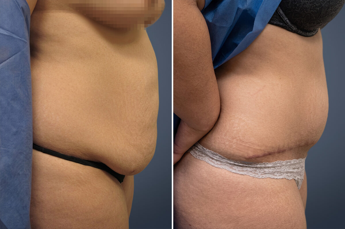 Before and after Tummy Tuck by Dr. David W. Allison, Patient 6057