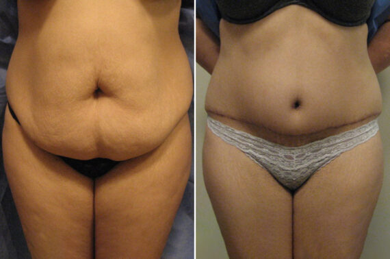 Before and after Tummy Tuck by Dr. David W. Allison, Patient 6057