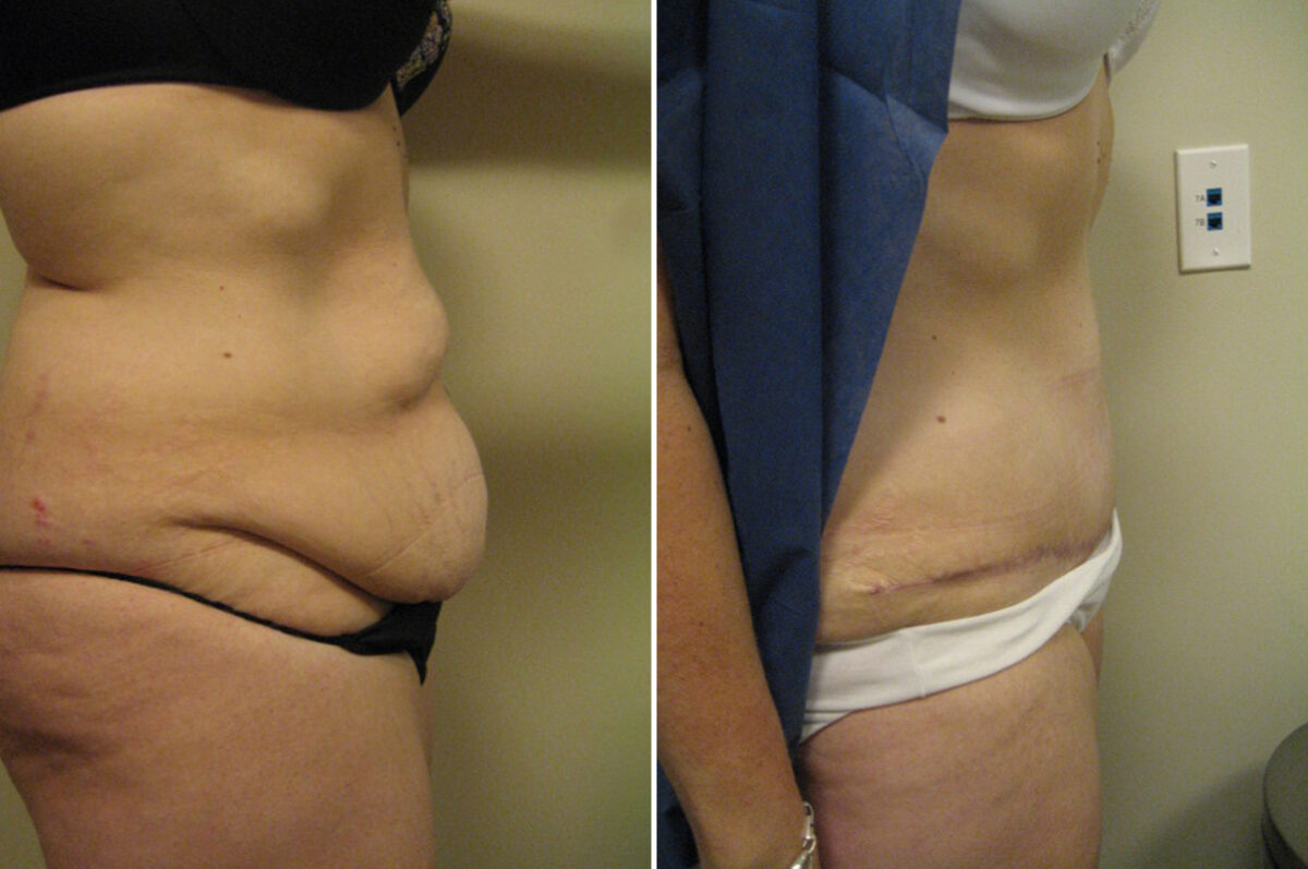 Before and after Tummy Tuck by Dr. David W. Allison, Patient 6064