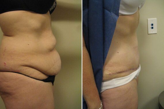 Before and after Tummy Tuck by Dr. David W. Allison, Patient 6064