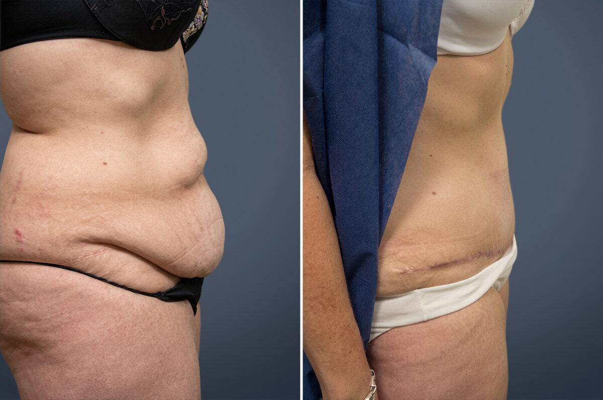 Before and after Tummy Tuck by Dr. David W. Allison, Patient 6064