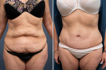 Before and after Tummy Tuck by Dr. David W. Allison, Patient 6064