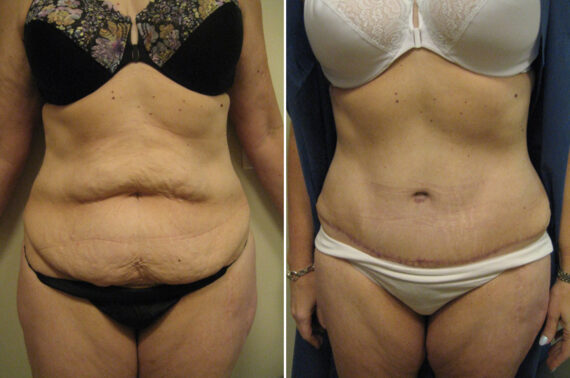 Before and after Tummy Tuck by Dr. David W. Allison, Patient 6064