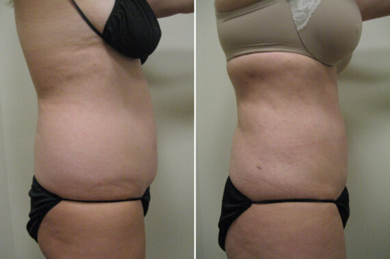 Before and after Liposuction by Dr. David W. Allison, Patient 6071