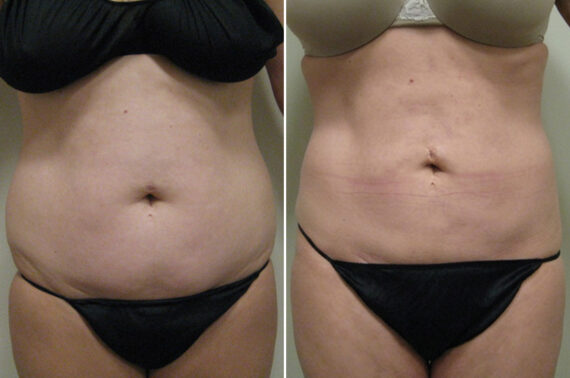 Before and after Liposuction by Dr. David W. Allison, Patient 6071
