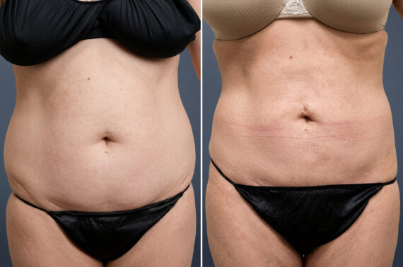 Liposuction before and after photos in Princeton, NJLiposuction Before and After Photos in Princeton, NJ