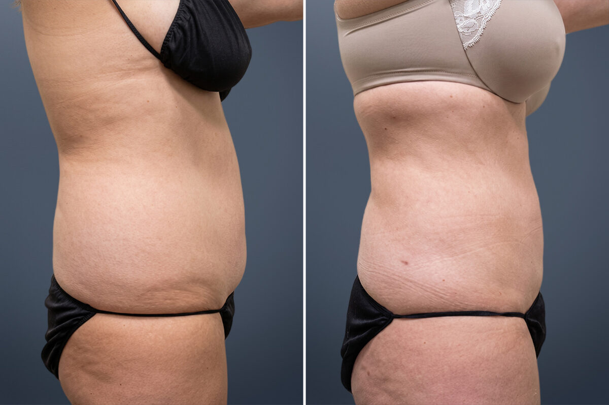 Before and after Liposuction by Dr. David W. Allison, Patient 6071