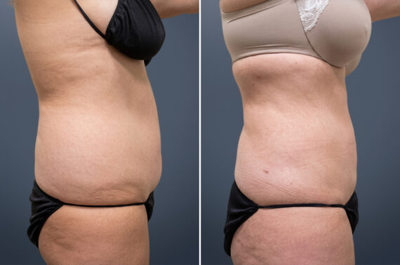 Before and after Liposuction by Dr. David W. Allison, Patient 6071
