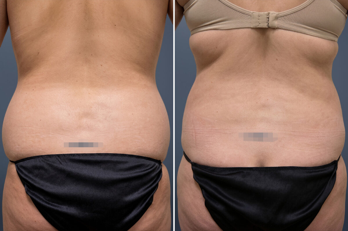 Before and after Liposuction by Dr. David W. Allison, Patient 6071