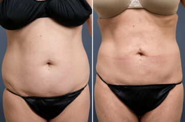 Before and after Liposuction by Dr. David W. Allison, Patient 6071