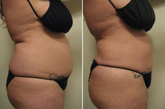 Before and after Liposuction by Dr. David W. Allison, Patient 6107