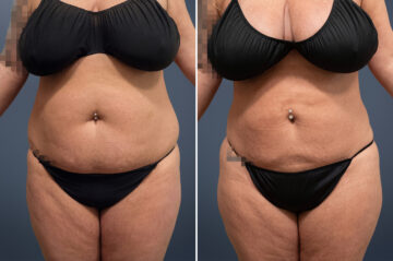 Before and after Liposuction by Dr. David W. Allison, Patient 6107