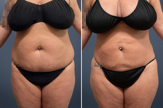 Liposuction before and after photos in Princeton, NJLiposuction Before and After Photos in Princeton, NJ