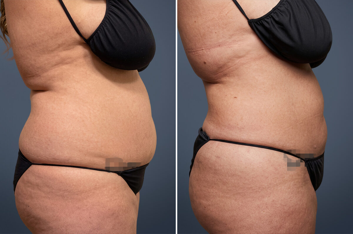 Before and after Liposuction by Dr. David W. Allison, Patient 6107