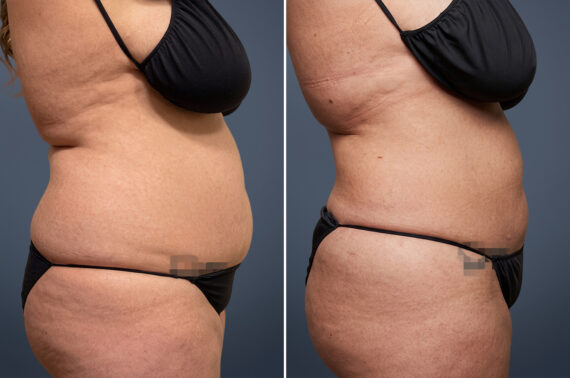 Before and after Liposuction by Dr. David W. Allison, Patient 6107