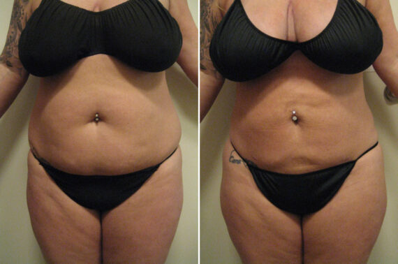 Before and after Liposuction by Dr. David W. Allison, Patient 6107