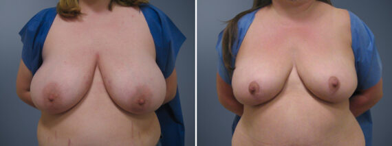 Before and after Breast Reduction by Dr. David W. Allison, Patient 6114