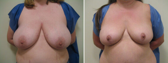 Before and after Breast Reduction by Dr. David W. Allison, Patient 6114