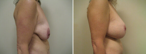 Before and after Breast Lift by Dr. David W. Allison, Patient 6123