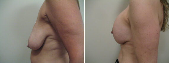 Before and after Breast Lift by Dr. David W. Allison, Patient 6127