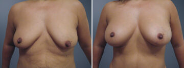Before and after Fat Transfer Breast Augmentation by Dr. David W. Allison, Patient 6131