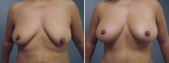Fat Transfer Breast Augmentation before and after photos in Princeton, NJFat Transfer Breast Augmentation Before and After Photos in Princeton, NJ