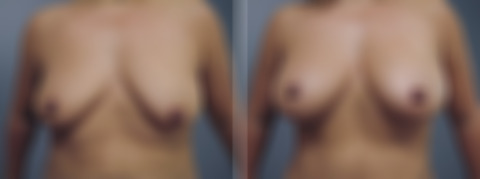 Fat Transfer Breast Augmentation before and after photos in Princeton, NJFat Transfer Breast Augmentation Before and After Photos in Princeton, NJ