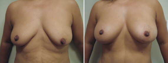 Before and after Fat Transfer Breast Augmentation by Dr. David W. Allison, Patient 6131