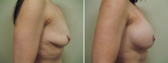 Before and after Breast Augmentation by Dr. David W. Allison, Patient 6135