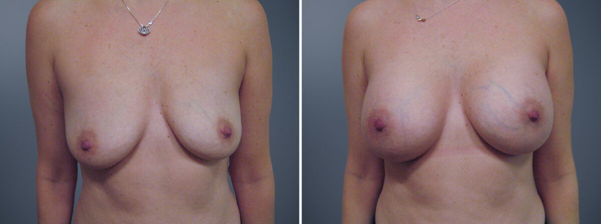 Before and after Breast Augmentation by Dr. David W. Allison, Patient 6139